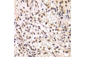 Immunohistochemistry of paraffin-embedded human kidney cancer using SMARCC1 antibody.