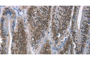 Immunohistochemistry of paraffin-embedded Human colon cancer tissue using GNRH1 Polyclonal Antibody at dilution 1:65 (GNRH1 antibody)