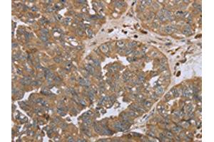The image on the left is immunohistochemistry of paraffin-embedded Human ovarian cancer tissue using ABIN7191695(NPR2 Antibody) at dilution 1/45, on the right is treated with synthetic peptide. (NPR2 antibody)