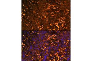 Immunofluorescence analysis of Human liver cancer using UGT1 antibody (ABIN6132769, ABIN6149895, ABIN6149896 and ABIN6221779) at dilution of 1:100.