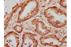 IHC image of ABIN7175822 diluted at 1:300 and staining in paraffin-embedded human colon cancer performed on a Leica BondTM system. (WAPAL antibody  (AA 1037-1190))
