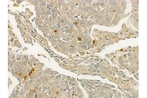 ABIN6257971 and ABIN6273840 at 1/100 staining human lung squamous cell carcinoma by IHC-P.