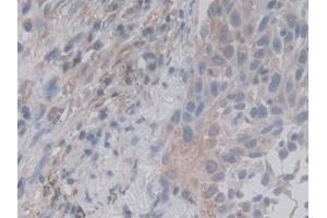 Detection of RALA in Human Lung cancer Tissue using Monoclonal Antibody to V-Ral Simian Leukemia Viral Oncogene Homolog A (RALA) (rala antibody  (AA 1-206))