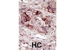 Formalin-fixed and paraffin-embedded human cancer tissue reacted with the primary antibody, which was peroxidase-conjugated to the secondary antibody, followed by DAB staining. (PHKG2 antibody  (AA 304-334))