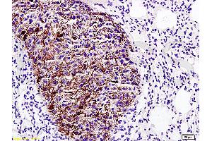 Formalin-fixed and paraffin embedded rat lung carcinoma labeled with Anti-Emp1/MUC1 Polyclonal Antibody (ABIN670086), Unconjugated at 1:200, followed by conjugation to the secondary antibody and DAB staining (EMP1 antibody  (AA 101-160))