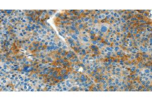 Immunohistochemistry of paraffin-embedded Human liver cancer tissue using L1CAM Polyclonal Antibody at dilution 1:40 (L1CAM antibody)