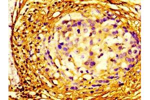 Immunohistochemistry of paraffin-embedded human breast cancer using ABIN7152106 at dilution of 1:100 (EIF4A2 antibody  (AA 1-407))