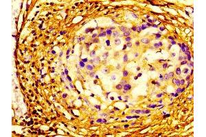 Immunohistochemistry of paraffin-embedded human breast cancer using ABIN7152106 at dilution of 1:100 (EIF4A2 antibody  (AA 1-407))