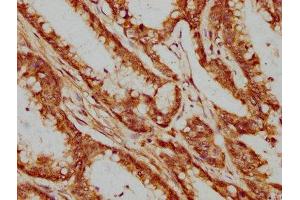 IHC image of ABIN7164186 diluted at 1:400 and staining in paraffin-embedded human colon cancer performed on a Leica BondTM system.