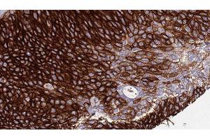 ABIN6276511 at 1/100 staining Human urothelial cancer tissue by IHC-P. (Nicastrin antibody  (C-Term))
