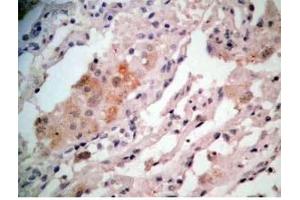 Human lung cancer tissue stained by Rabbit-Anti-GRP Pro (80-97) (H) Antibody (Gastrin-Releasing Peptide antibody  (AA 80-97))