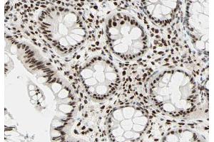 ABIN6266586 at 1/100 staining human colon carcinoma tissue sections by IHC-P.