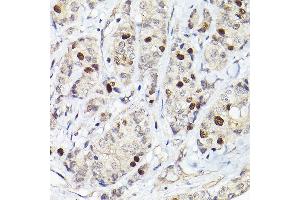 Immunohistochemistry of paraffin-embedded human breast cancer using RG Rabbit pAb (ABIN6127968, ABIN6146621, ABIN6220915 and ABIN6220916) at dilution of 1:50 (40x lens). (RACGAP1 antibody  (AA 353-632))