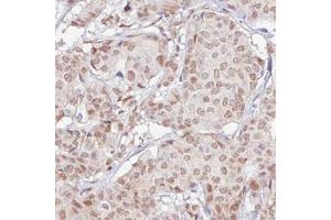 Immunohistochemical staining (Formalin-fixed paraffin-embedded sections) of human breast cancer with RBM3 monoclonal antibody, clone CL0296  shows moderate nuclear positivity in tumor cells. (RBM3 antibody)