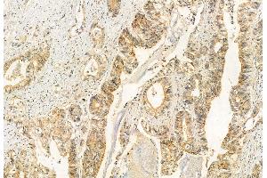 ABIN6260960 and ABIN6272912 at 1/100 staining Human normal tissues adjacent to colorectal cancer by IHC-P. (COMMD1 antibody  (Internal Region))