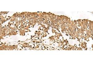 Immunohistochemistry of paraffin-embedded Human lung cancer tissue using PSMA3 Polyclonal Antibody at dilution of 1:50(x200)