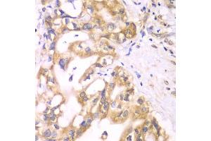 Immunohistochemistry of paraffin-embedded human liver cancer using ACADS antibody (ABIN5970342) at dilution of 1/100 (40x lens). (ACADS antibody)