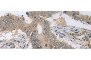 Immunohistochemistry of paraffin-embedded Human colon cancer tissue using P2RY11 Polyclonal Antibody at dilution of 1:30(x200) (P2RY11 antibody)