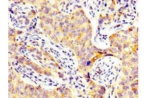 IHC image of ABIN7147182 diluted at 1:300 and staining in paraffin-embedded human pancreatic cancer performed on a Leica BondTM system. (CD82 antibody  (AA 111-228))