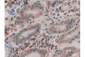 Detection of PDIA4 in Human Stomach cancer Tissue using Polyclonal Antibody to Protein Disulfide Isomerase A4 (PDIA4) (PDIA4 antibody  (AA 505-636))