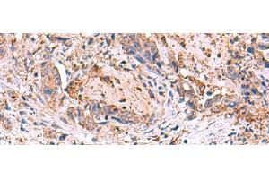 Immunohistochemistry of paraffin-embedded Human cervical cancer tissue using MPP1 Polyclonal Antibody at dilution of 1:50(x200) (MPP1 antibody)