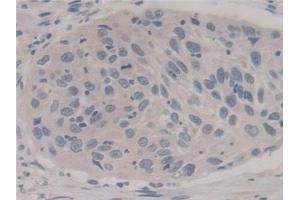 Detection of FIS1 in Human Lung cancer Tissue using Polyclonal Antibody to Fission 1 (FIS1) (Fission 1 antibody  (AA 1-117))
