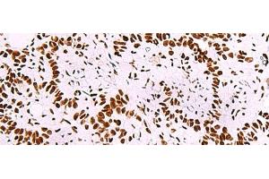 Immunohistochemistry of paraffin-embedded Human ovarian cancer tissue using TRIM28(phospho-Ser824) Polyclonal Antibody at dilution of 1:50(x200) (KAP1 antibody  (pSer824))