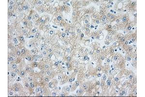 Immunohistochemical staining of paraffin-embedded Carcinoma of Human liver tissue using anti-H6PD mouse monoclonal antibody.