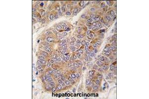 Formalin-fixed and paraffin-embedded human hepatocarcinoma tissue reacted with APOA2 antibody , which was peroxidase-conjugated to the secondary antibody, followed by DAB staining.