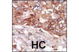 Formalin-fixed and paraffin-embedded human cancer tissue reacted with the primary antibody, which was peroxidase-conjugated to the secondary antibody, followed by AEC staining. (BLK antibody  (N-Term))