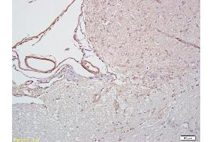 Formalin-fixed and paraffin embedded human cervical cancer labeled with Anti-ICAM-2/CD102 Polyclonal Antibody, Unconjugated (ABIN674049) followed by conjugation to the secondary antibody and DAB staining (ICAM2 antibody  (AA 175-277))