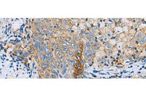 Immunohistochemistry of paraffin-embedded Human cervical cancer tissue using CLTB Polyclonal Antibody at dilution of 1:70(x200) (CLTB antibody)