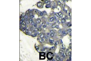 Formalin-fixed and paraffin-embedded human breast carcinoma reacted with PIK3CD polyclonal antibody  , which was peroxidase-conjugated to the secondary antibody, followed by DAB staining. (PIK3CD antibody  (N-Term))