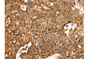 The image on the left is immunohistochemistry of paraffin-embedded Human breast cancer tissue using ABIN7192683(STK32B Antibody) at dilution 1/25, on the right is treated with synthetic peptide. (STK32B antibody)