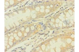 Immunohistochemistry of paraffin-embedded human colon cancer using ABIN7166896 at dilution of 1:100 (PDHA1 antibody  (AA 223-390))