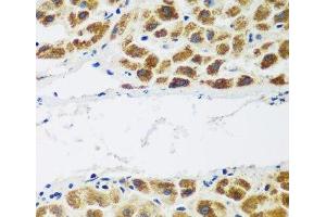Immunohistochemistry of paraffin-embedded Human liver cancer using NAA60 Polyclonal Antibody at dilution of 1:200 (40x lens). (NAT15 antibody)