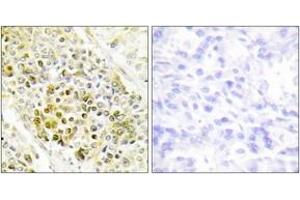 Immunohistochemistry analysis of paraffin-embedded human lung carcinoma tissue, using DLX5 Antibody. (DLX5 antibody  (AA 91-140))
