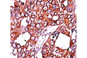 IHC analysis of FFPE human breast carcinoma tissue stained with the CDC25A antibody. (CDC25A antibody  (pThr507))