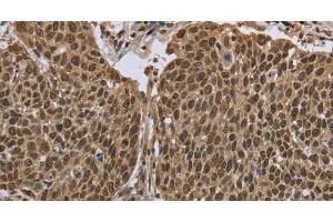 Immunohistochemistry of paraffin-embedded Human cervical cancer using PPAT Polyclonal Antibody at dilution of 1:50 (PPAT antibody)