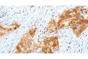 Immunohistochemistry of paraffin-embedded Human cervical cancer using ANXA8 Polyclonal Antibody at dilution of 1:35 (Annexin VIII antibody)