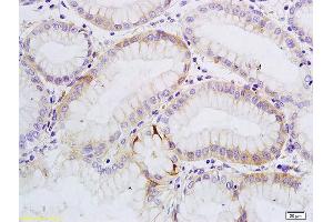 Formalin-fixed and paraffin embedded human gastric cancer labeled with Anti-SATB1 Polyclonal Antibody, Unconjugated (ABIN732008) followed by conjugation to the secondary antibody and DAB staining (SATB1 antibody  (AA 671-764))