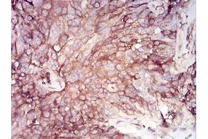 Immunohistochemical analysis of paraffin-embedded bladder cancer tissues using SERPINA1 mouse mAb with DAB staining. (SERPINA1 antibody  (AA 23-237))