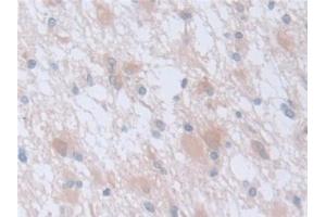 Detection of CAPNS1 in Human Glioma Tissue using Polyclonal Antibody to Calpain, Small Subunit 1 (CAPNS1) (Calpain S1 antibody  (AA 1-268))