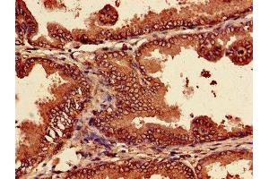Immunohistochemistry of paraffin-embedded human prostate cancer using ABIN7164964 at dilution of 1:100 (PSMA7 antibody  (AA 5-232))