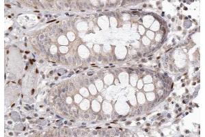 ABIN6267262 at 1/200 staining human colon carcinoma tissue sections by IHC-P. (EGFR antibody  (pTyr1097))