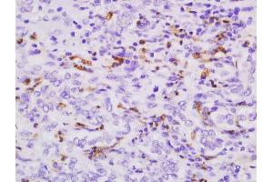 Formalin-fixed and paraffin embedded human cholangiocarcinoma tissue labeled with Anti-S100-A9 Polyclonal Antibody, Unconjugated  followed by conjugation to the secondary antibody and DAB staining. (S100A9 antibody  (AA 51-114))