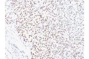 Formalin-fixed, paraffin-embedded human melanoma stained with MITF antibody (D5). (MITF antibody  (N-Term))