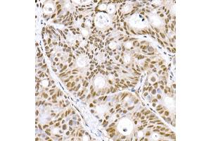Immunohistochemistry of paraffin-embedded human colon carcinoma using Prdm9 Rabbit mAb (ABIN7269500) at dilution of 1:800 (40x lens). (PRDM9 antibody)
