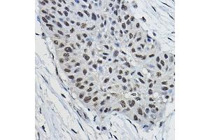 Immunohistochemistry of paraffin-embedded human lung cancer using BRAP Rabbit pAb (ABIN7265922) at dilution of 1:100 (40x lens). (BRAP antibody  (AA 1-200))