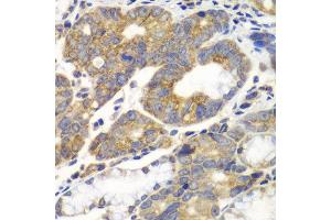 Immunohistochemistry of paraffin-embedded human gastric cancer using PFKM antibody at dilution of 1:100 (x40 lens). (PFKM antibody)